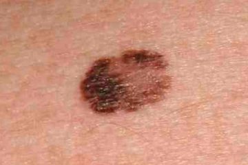 melanoma